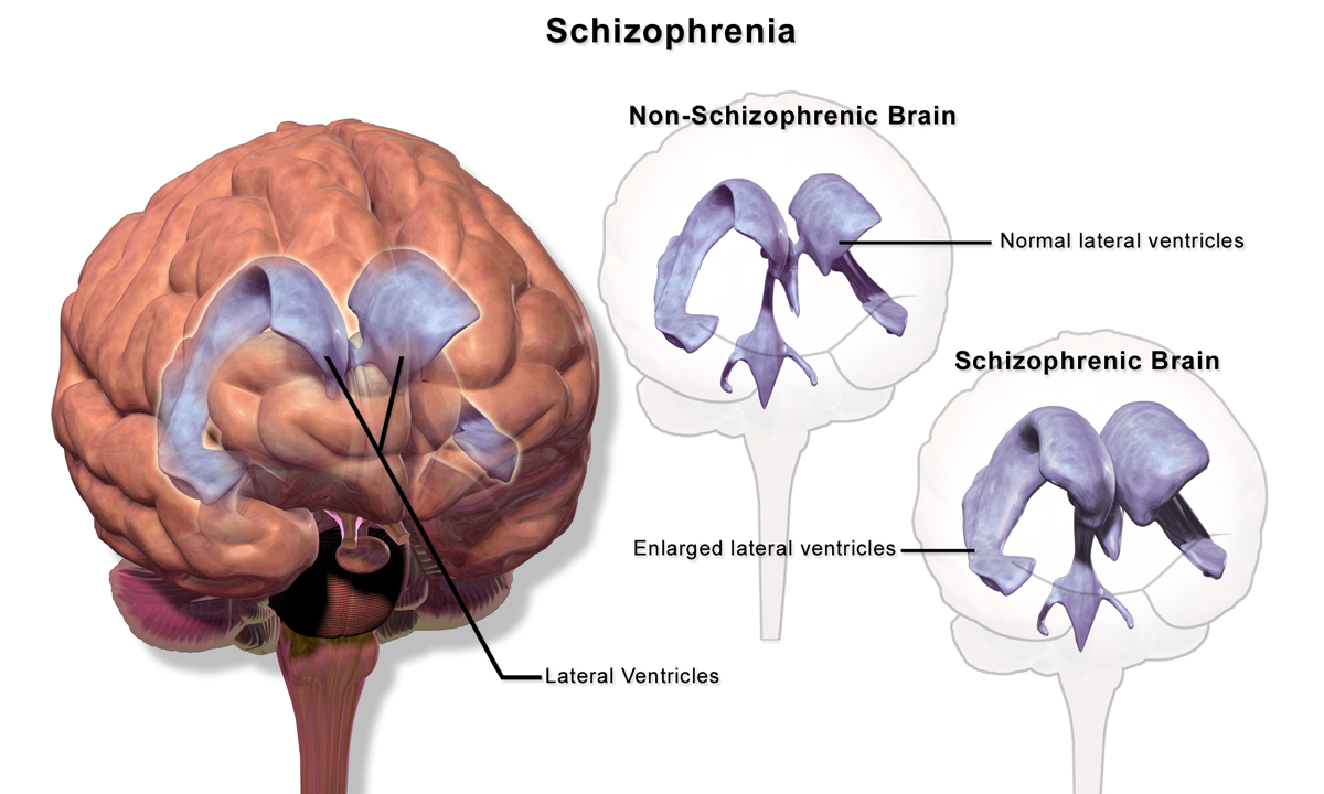 7. schizophrenia